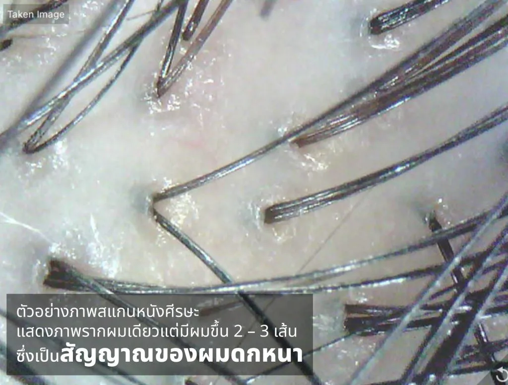 ภาพสแกน 1 รากผม มีผมงอกหลายเน