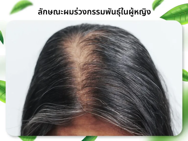 ผมร่วงกรรมพันธุ์ในผู้หญิง