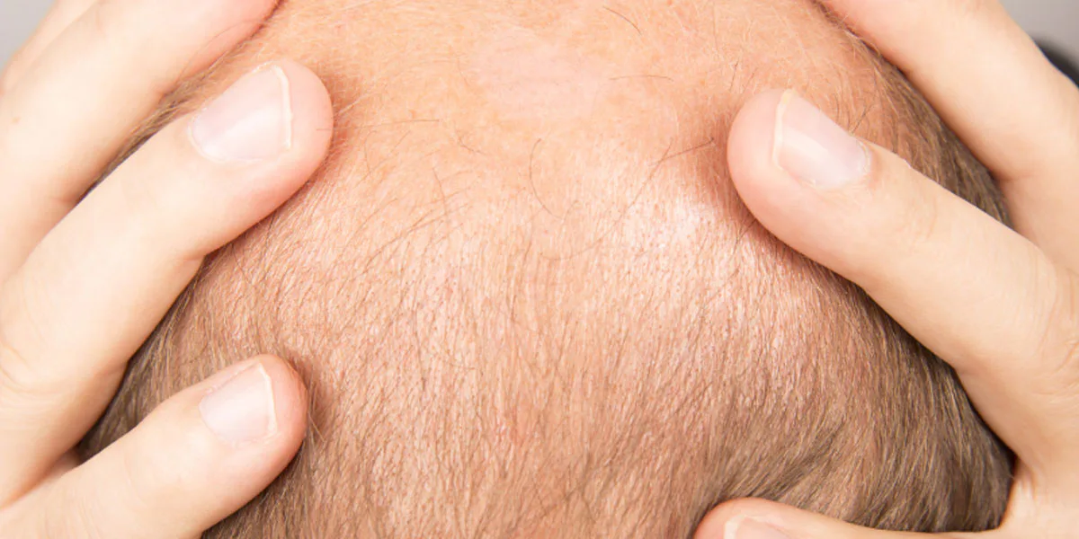 How to deal with hereditary hair loss and thinning