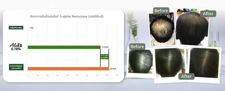 AloEx နှင့် Finasteride နှိုင်းယှဉ်ချက်