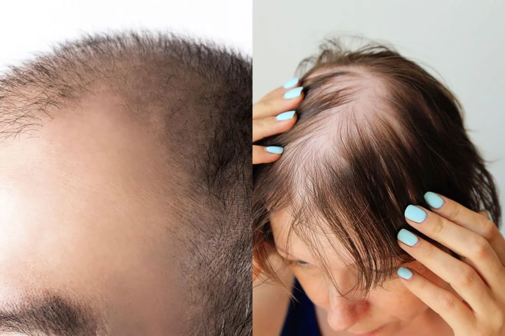 Using Minoxidil for hair loss