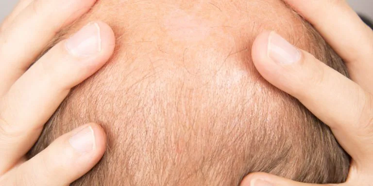How to deal with hereditary hair loss and thinning
