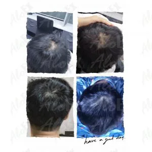 Before & After Reviews — AloEx Products