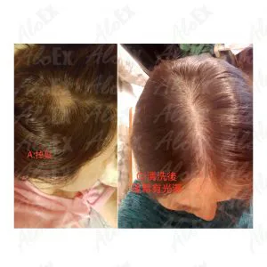 Before & After Reviews — AloEx Products
