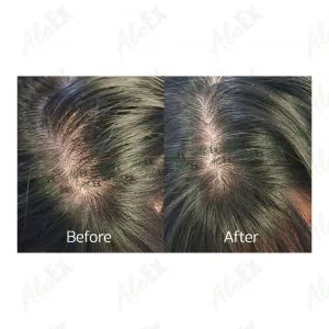 Before & After Reviews — AloEx Products