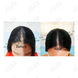 Before & After Reviews — AloEx Products