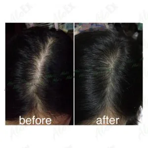 Before & After Reviews — AloEx Products