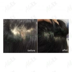 Before & After Reviews — AloEx Products