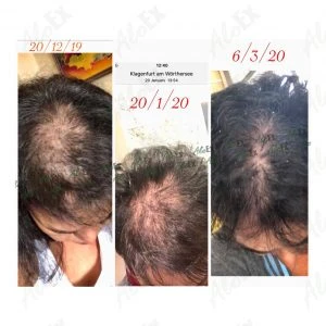 Before & After Reviews — AloEx Products