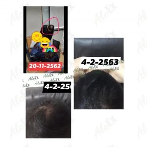 Before & After Reviews — AloEx Products