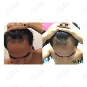Before & After Reviews — AloEx Products