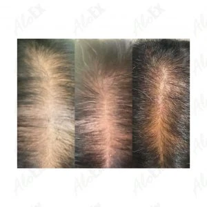 Before & After Reviews — AloEx Products