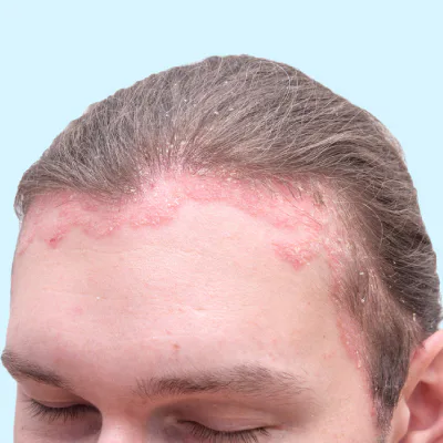 Scalp burning and redness