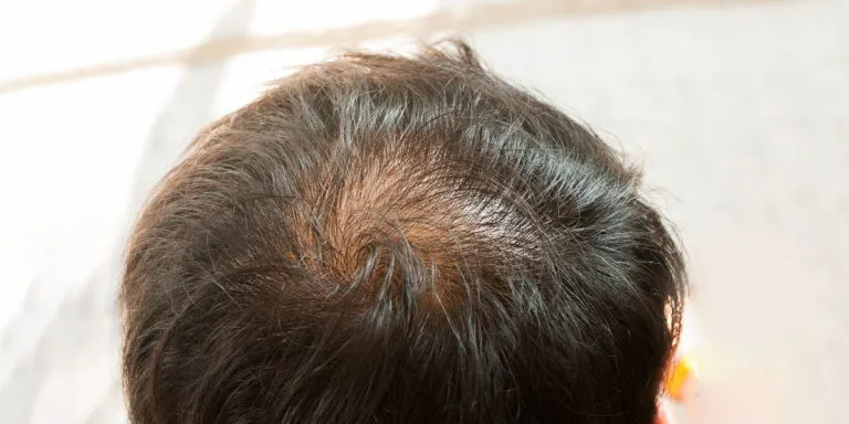 Tips for solving oily scalp for men