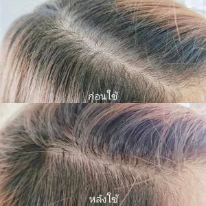 เซรั่มของ AloEx ตัวนี้คือช่วยลดอาการผมร่วงได้ดีมาก