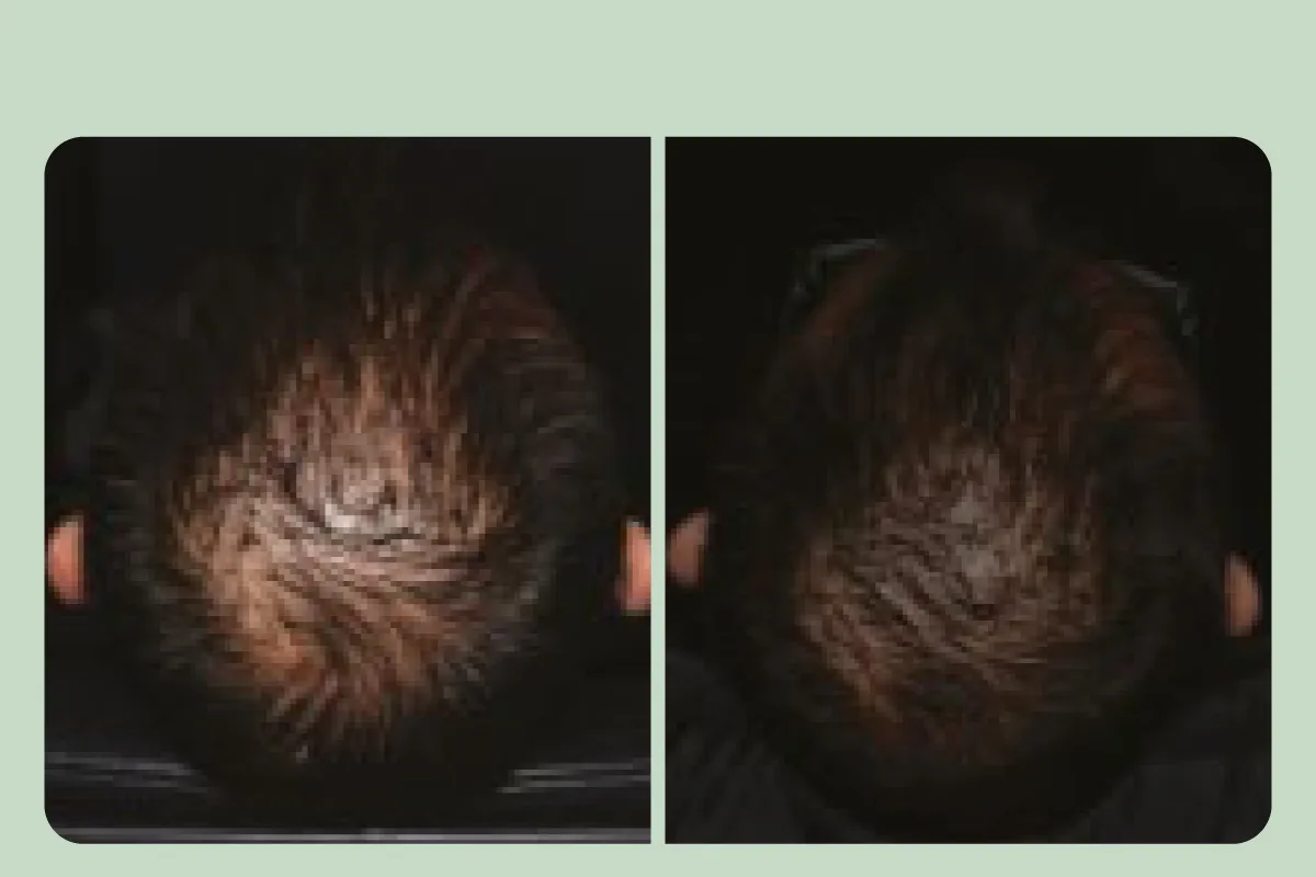 ภาพเปรียบเทียบก่อนและหลังของอาสาสมัครที่ใช้ Redensyl เป็นเวลา 3 เดือน เห็นผมบริเวณกลางศีรษะหนาแน่นขึ้น