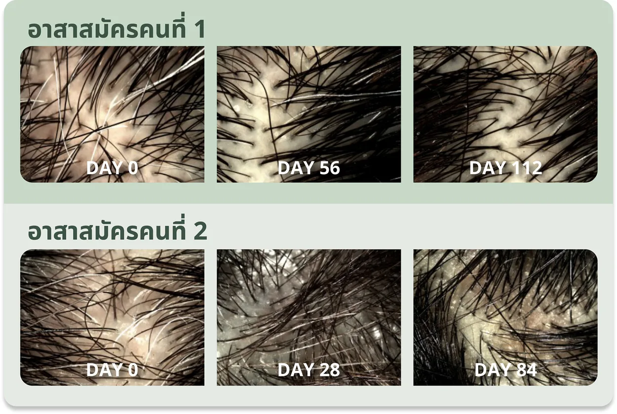 ภาพถ่ายกล้องจุลทรรศน์หนังศีรษะของอาสาสมัคร 2 คน คนที่ 1 เปรียบเทียบวันที่ 0, 56 และ 112 คนที่ 2 เปรียบเทียบวันที่ 0, 28 และ 84 เห็นเส้นผมหนาแน่นขึ้นและผมหงอกลดลงหลังใช้ Densidyl 2%