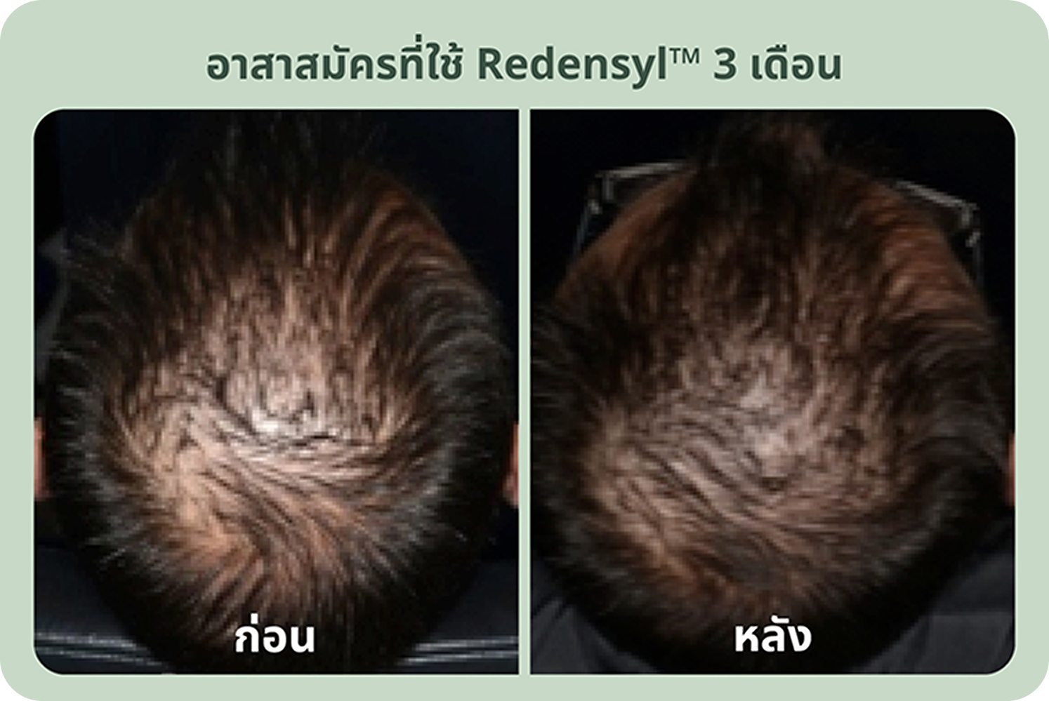 อาสาสมัครที่ใช้ redensyl 3 เดือน